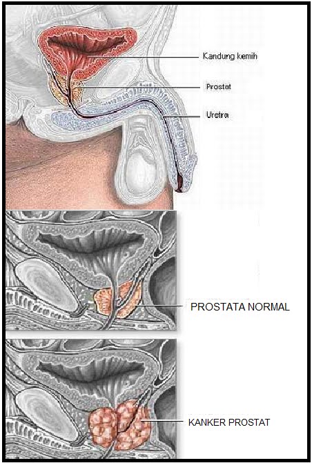 apa itu kanker kelenjar prostat apa itu kanker kelenjar prostat